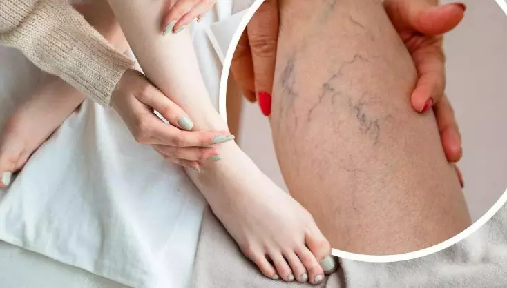 Sosudistye Setochki Na Nogah