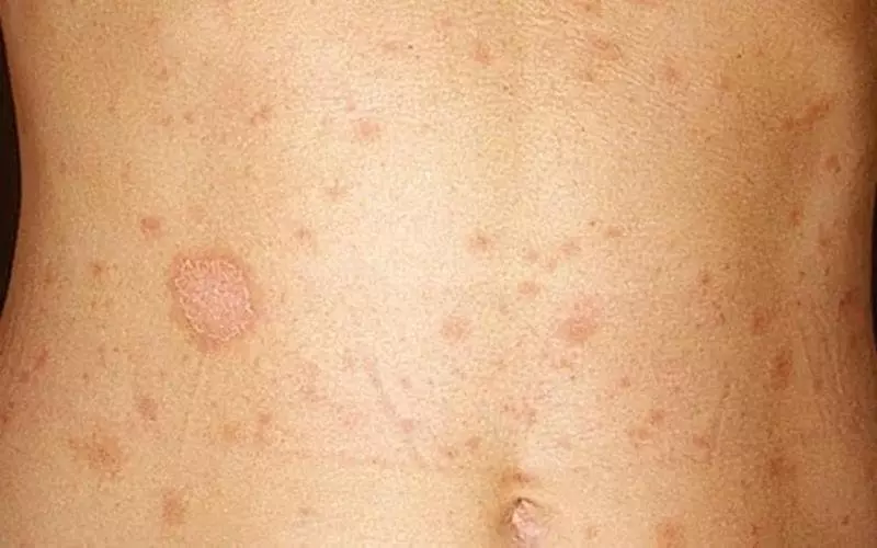 Vysivkopodibnyy Lyshay Plyamy Na Shkiri